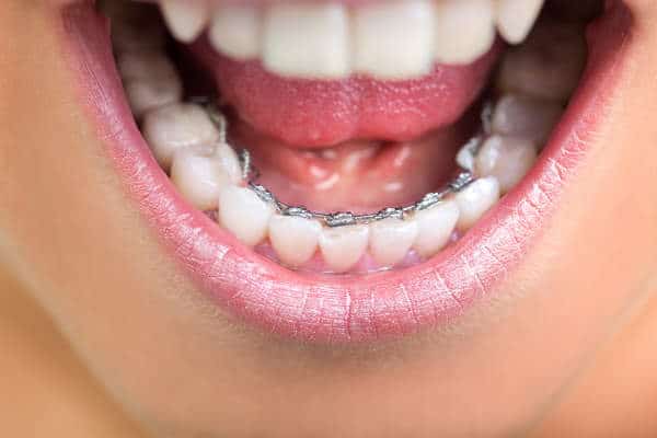 Lingual Braces in Ault