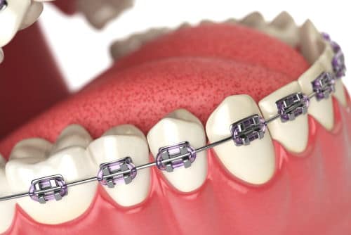 dental braces on lower arch