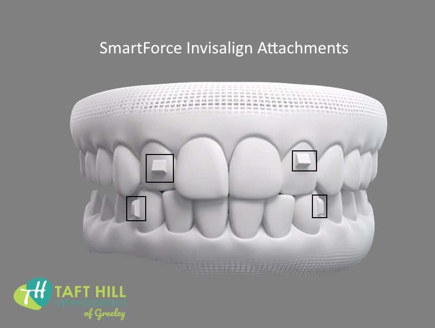 Invisalign Attachments Explained: how they work to help with your